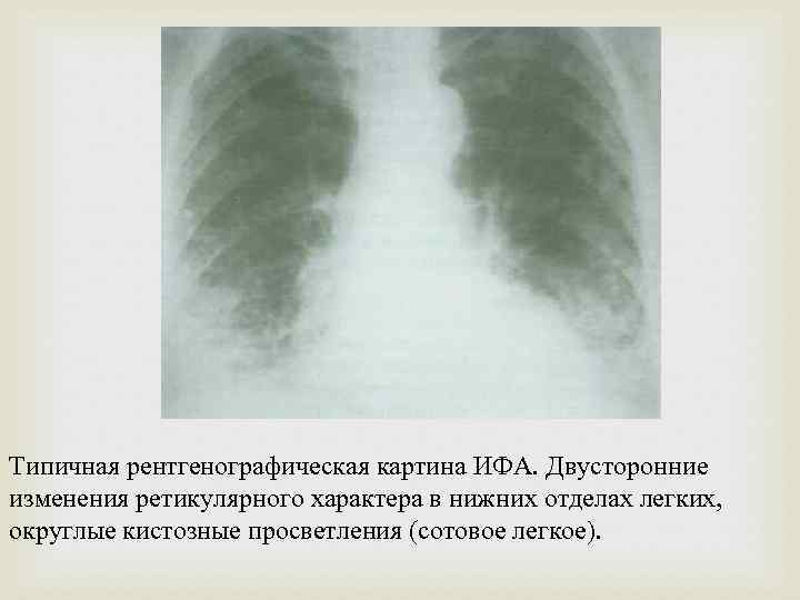 Какая рентгенологическая картина характерна для легочного фиброза