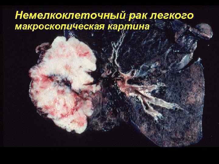 Немелкоклеточный рак легкого макроскопическая картина 