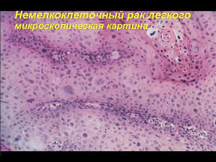Немелкоклеточный рак легкого микроскопическая картина 
