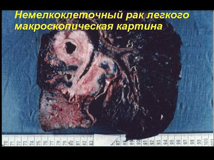 Немелкоклеточный рак легкого макроскопическая картина 