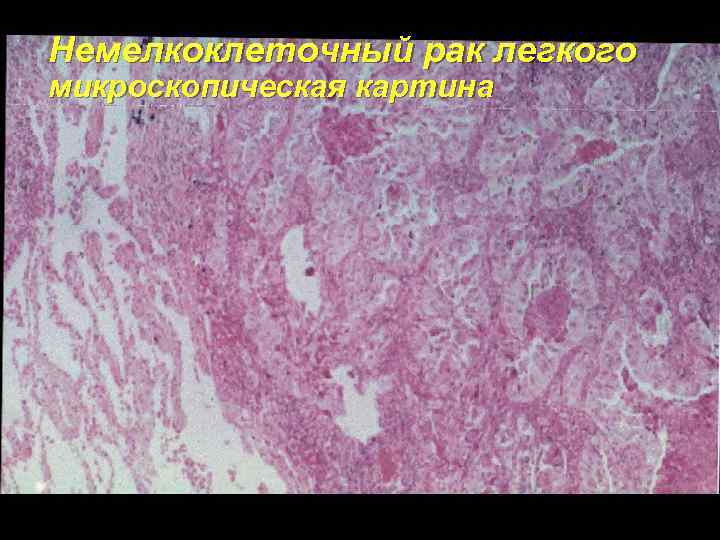 Немелкоклеточный рак легкого микроскопическая картина 