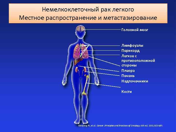 Немелкоклеточный рак легкого Местное распространение и метастазирование Головной мозг Лимфоузлы Перикард Легкое с противоположной