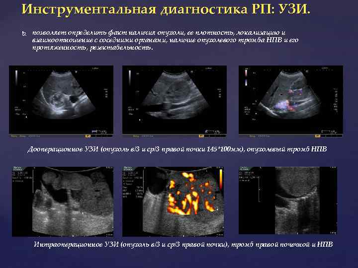 Инструментальная диагностика РП: УЗИ. позволяет определить факт наличия опухоли, ее плотность, локализацию и взаимоотношение
