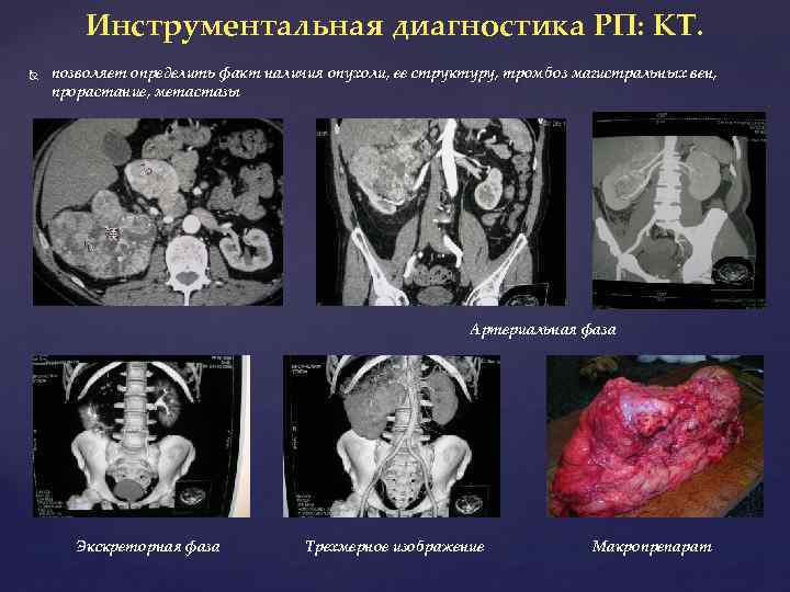 Инструментальная диагностика РП: КТ. позволяет определить факт наличия опухоли, ее структуру, тромбоз магистральных вен,