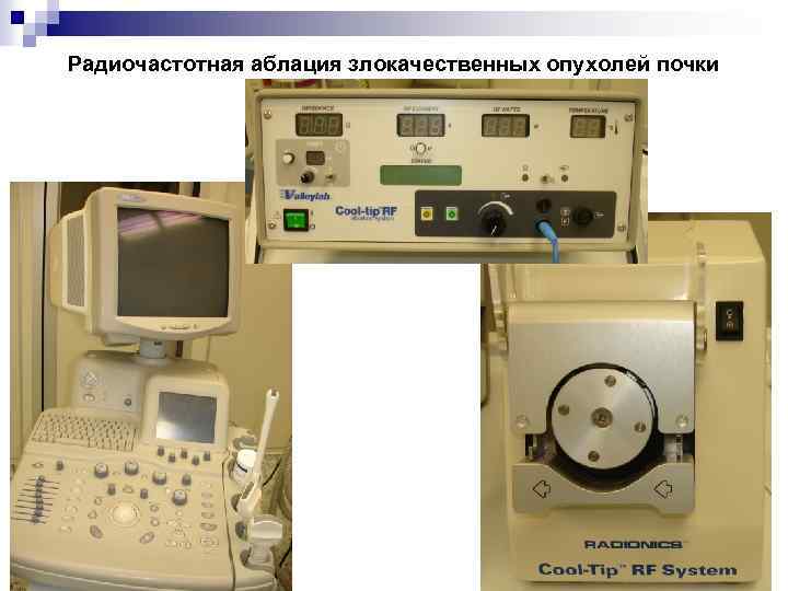 Радиочастотная аблация злокачественных опухолей почки 