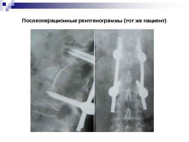 Послеоперационные рентгенограммы (тот же пациент) 