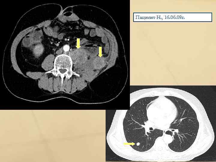 Пациент Н. , 16. 09 г. 