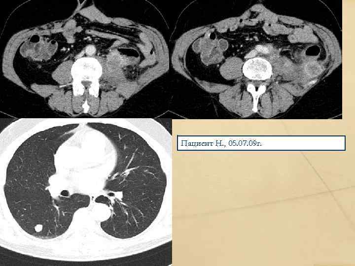 Пациент Н. , 05. 07. 09 г. 