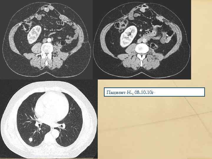 Пациент Н. , 08. 10 г 