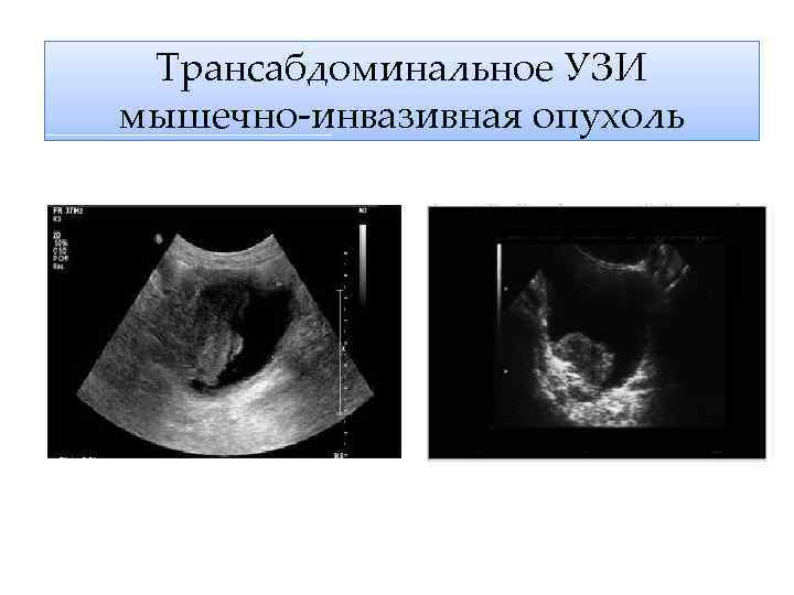 Трансабдоминальное узи. Трансабдоминальное УЗИ мочевого пузыря. Трансабдоминальное УЗИ опухоли матки.