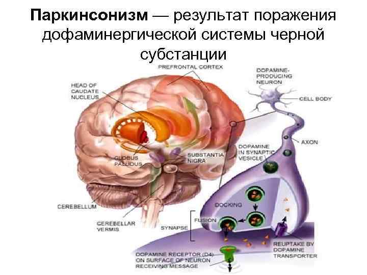 Паркинсонизм — результат поражения дофаминергической системы черной субстанции 