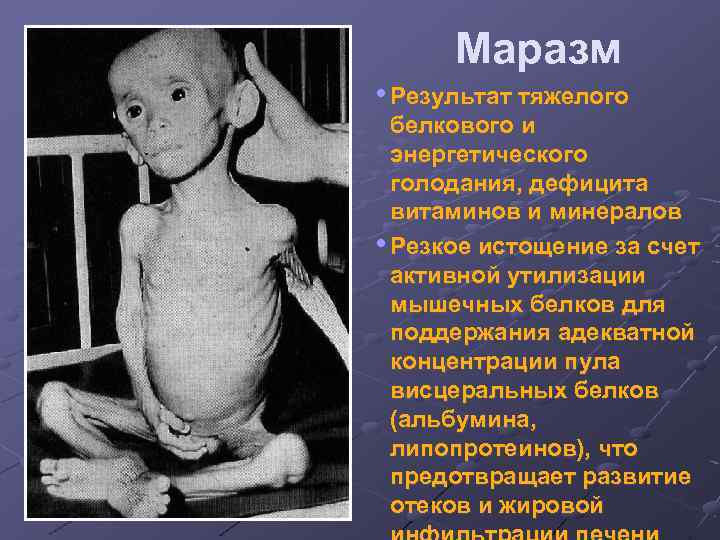 Маразм • Результат тяжелого белкового и энергетического голодания, дефицита витаминов и минералов • Резкое