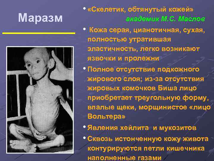 Маразм • «Скелетик, обтянутый кожей» академик М. С. Маслов • Кожа серая, цианотичная, сухая,