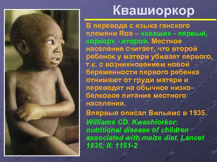 Квашиоркор В переводе с языка ганского племени Roa – «кваши» - первый, «оркор» -