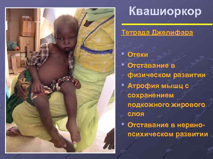 Квашиоркор Тетрада Джелифара • Отеки • Отставание в физическом развитии • Атрофия мышц с