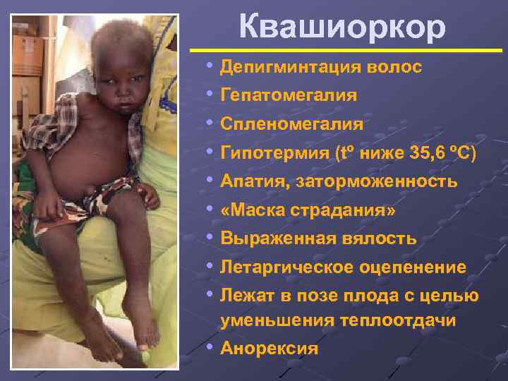 Квашиоркор • Депигминтация волос • Гепатомегалия • Спленомегалия • Гипотермия (tº ниже 35, 6