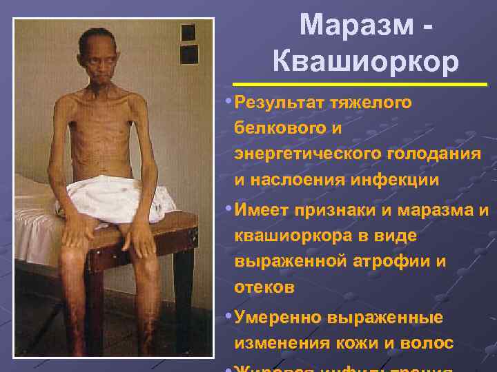 Маразм Квашиоркор • Результат тяжелого белкового и энергетического голодания и наслоения инфекции • Имеет