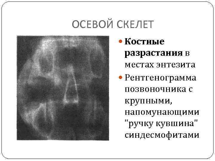 ОСЕВОЙ СКЕЛЕТ Костные разрастания в местах энтезита Рентгенограмма позвоночника с крупными, напомунающими 