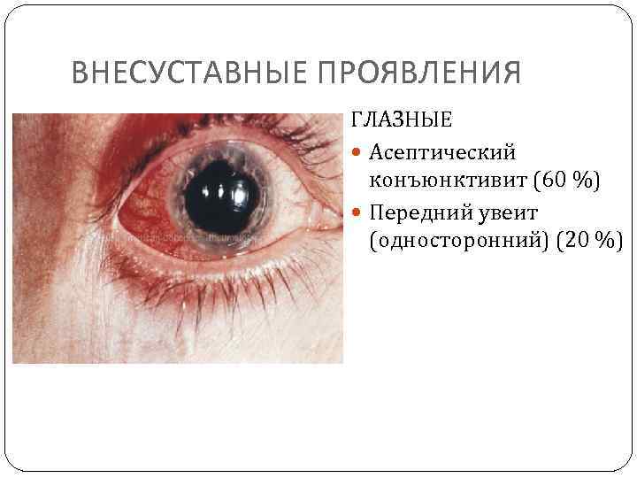 ВНЕСУСТАВНЫЕ ПРОЯВЛЕНИЯ ГЛАЗНЫЕ Асептический конъюнктивит (60 %) Передний увеит (односторонний) (20 %) 