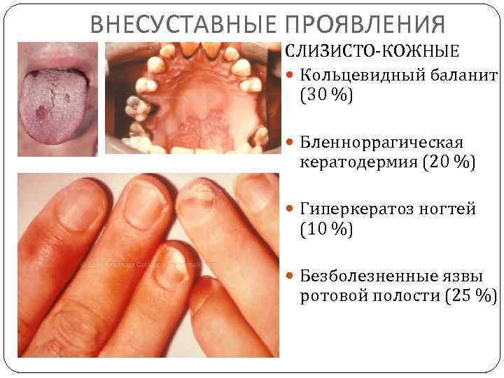 ВНЕСУСТАВНЫЕ ПРОЯВЛЕНИЯ СЛИЗИСТО-КОЖНЫЕ Кольцевидный баланит (30 %) Бленноррагическая кератодермия (20 %) Гиперкератоз ногтей (10