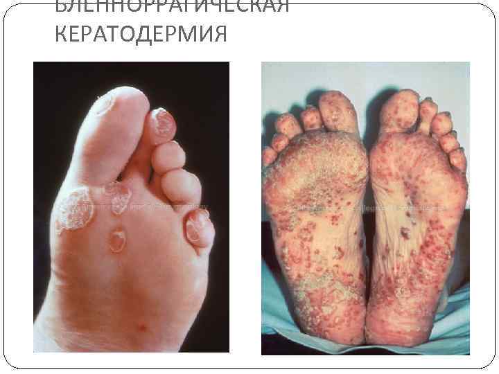 БЛЕННОРРАГИЧЕСКАЯ КЕРАТОДЕРМИЯ 