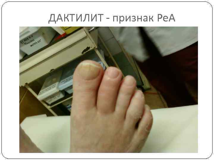 ДАКТИЛИТ - признак Ре. А 