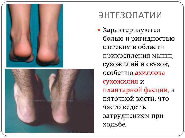 ЭНТЕЗОПАТИИ Характеризуются болью и ригидностью с отеком в области прикрепления мышц, сухожилий и связок,