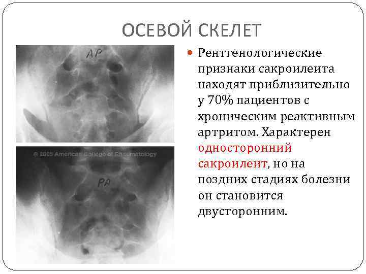 ОСЕВОЙ СКЕЛЕТ Рентгенологические признаки сакроилеита находят приблизительно у 70% пациентов с хроническим реактивным артритом.