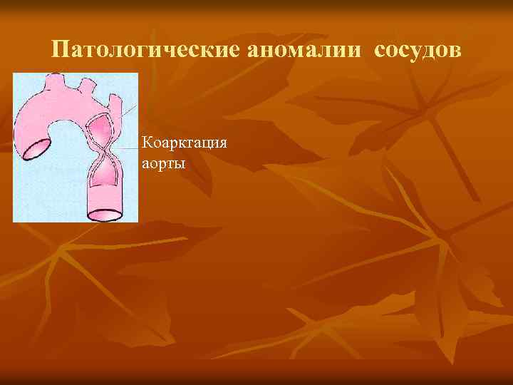 Патологические аномалии сосудов Коарктация аорты 