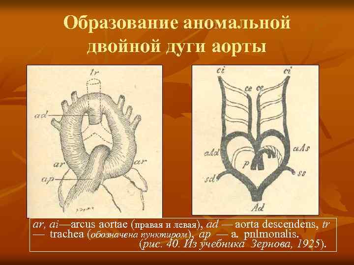 Образование аномальной двойной дуги аорты ar, ai—arcus aortae (правая и левая), ad — aorta