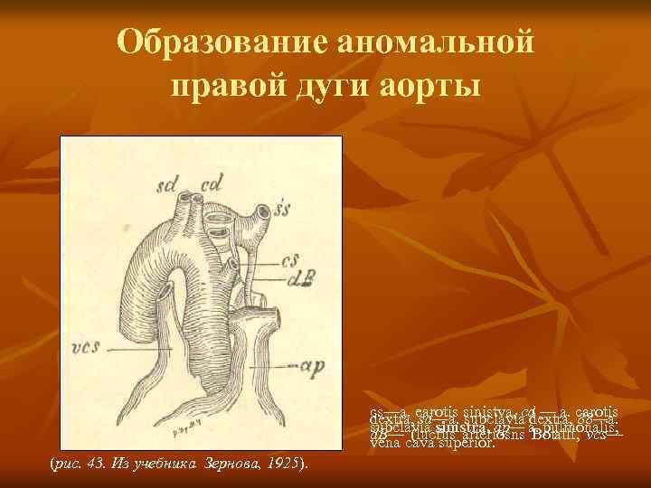 Образование аномальной правой дуги аорты cs—a. earotis sinistva, cd — a. carotis dextra, sd—a.