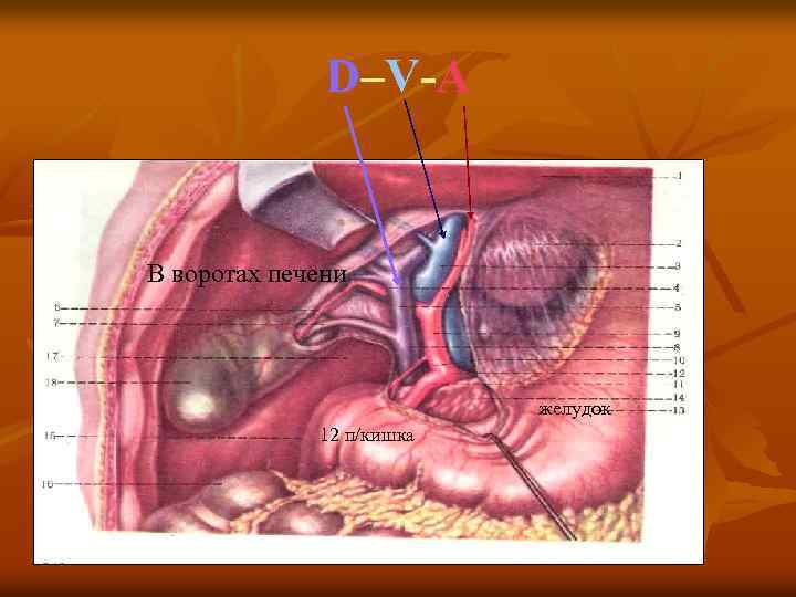 D–V-A В воротах печени желудок 12 п/кишка 