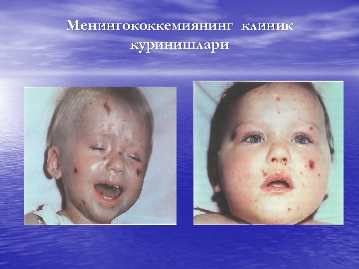 Менингококкемиянинг клиник куринишлари 