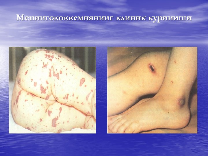 Менингококкемиянинг клиник куриниши 