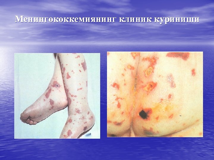 Менингококкемиянинг клиник куриниши 