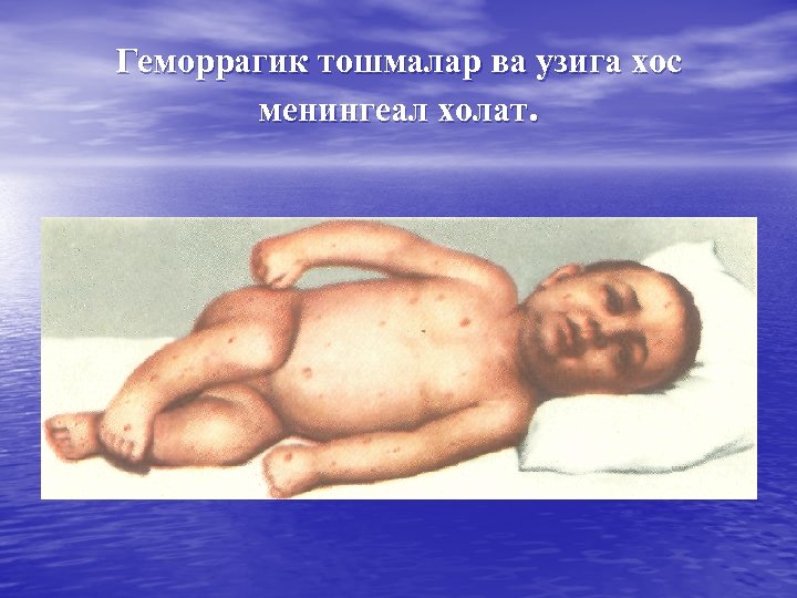 Геморрагик тошмалар ва узига хос менингеал холат. 