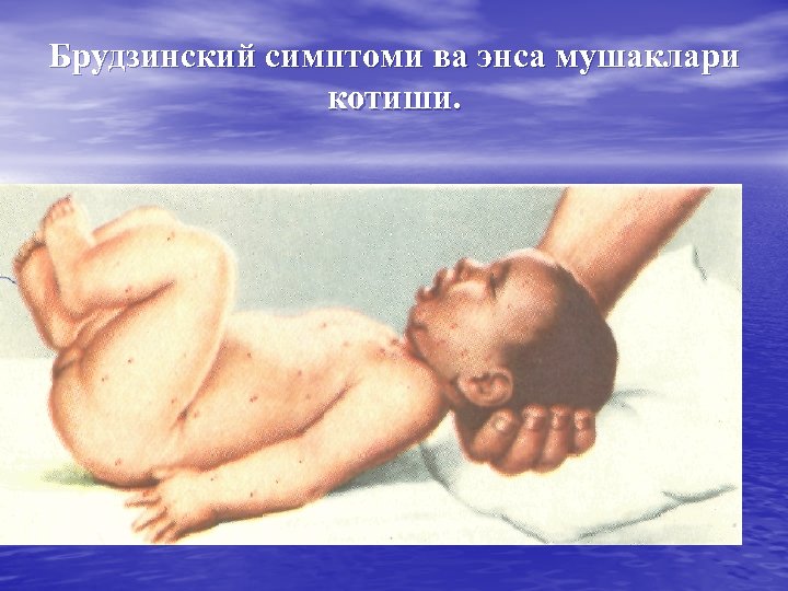 Брудзинский симптоми ва энса мушаклари котиши. 