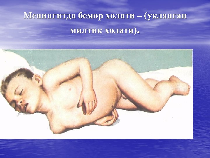 Менингитда бемор холати – (укланган милтик холати). 