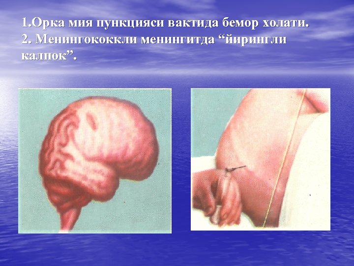 1. Орка мия пункцияси вактида бемор холати. 2. Менингококкли менингитда “йирингли калпок”. 