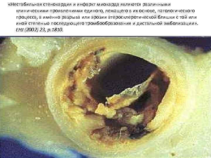  «Нестабильная стенокардия и инфаркт миокарда являются различными клиническими проявлениями единого, лежащего в их
