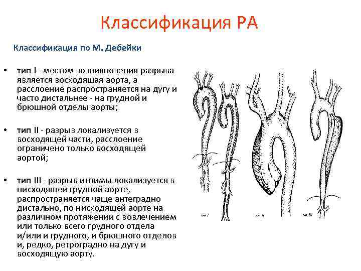 Классификация РА Классификация по М. Дебейки • тип I - местом возникновения разрыва является