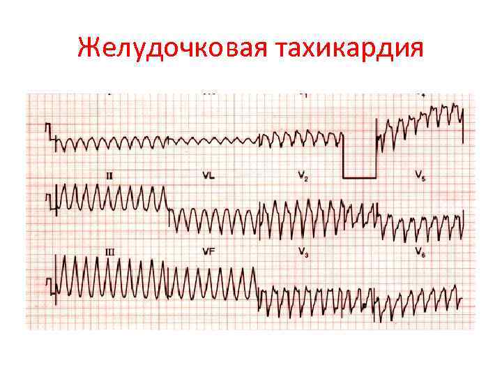 Желудочковая тахикардия 