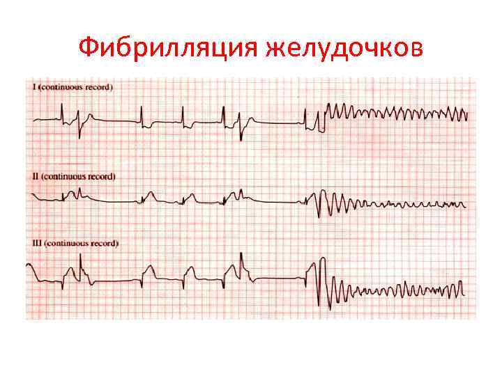 Фибрилляция желудочков 