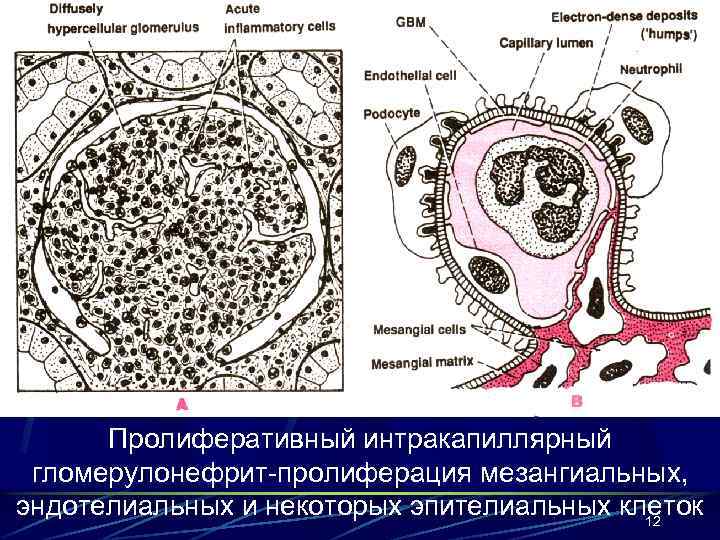 Пролиферативный интракапиллярный гломерулонефрит-пролиферация мезангиальных, эндотелиальных и некоторых эпителиальных клеток 12 