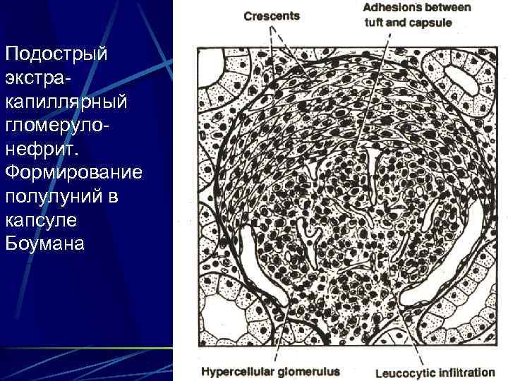 Подострый экстракапиллярный гломерулонефрит. Формирование полулуний в капсуле Боумана 16 