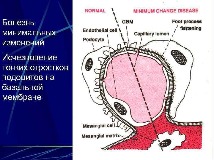 Болезнь минимальных изменений Исчезновение тонких отростков подоцитов на базальной мембране 20 