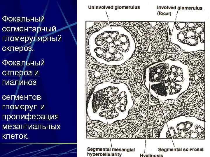 Фокальный сегментарный гломерулярный склероз. Фокальный склероз и гиалиноз сегментов гломерул и пролиферация мезангиальных клеток.