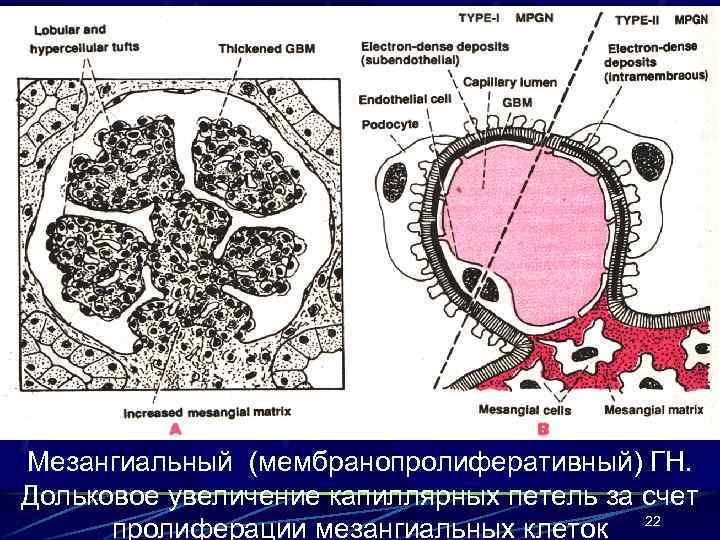 Мезангиальный (мембранопролиферативный) ГН. Дольковое увеличение капиллярных петель за счет пролиферации мезангиальных клеток 22 