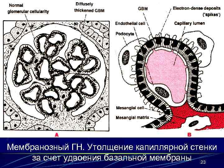 Мембранозный ГН. Утолщение капиллярной стенки за счет удвоения базальной мембраны 23 