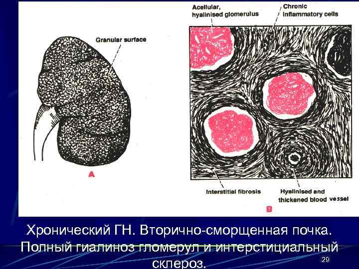 Хронический ГН. Вторично-сморщенная почка. Полный гиалиноз гломерул и интерстициальный 29 склероз. 